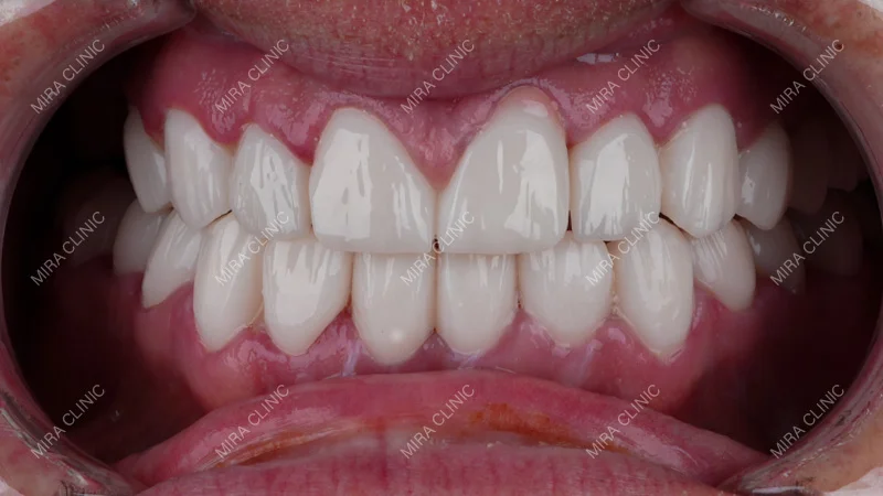 Zirconium Crowns